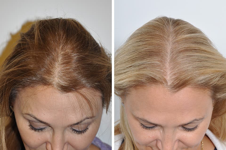 Discover the Best Hair Transplant London Has to Offer