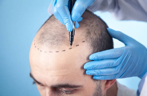 Hair Transplant Price Explained by Vivid Clinic Experts
