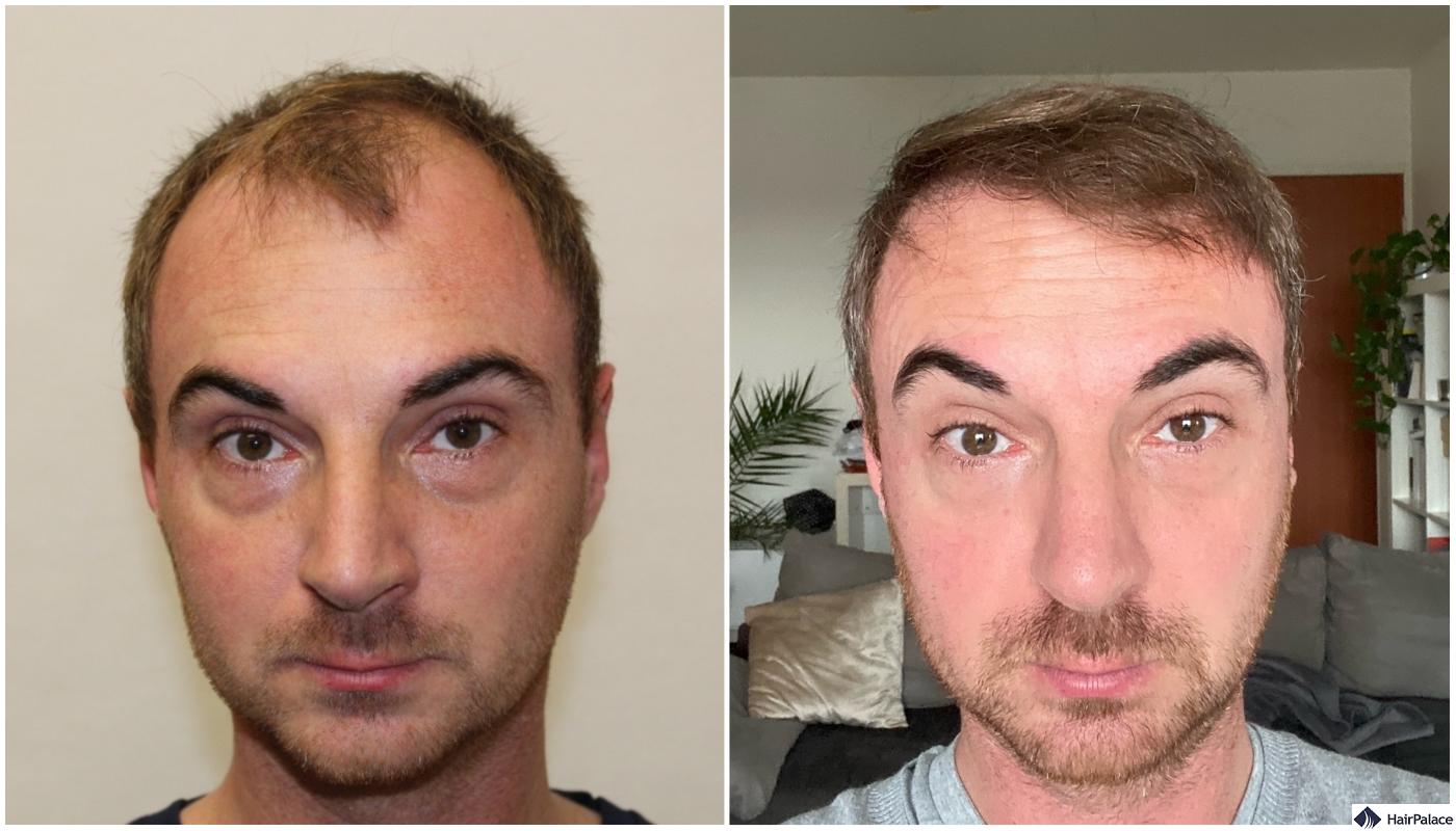 Hair Transplant London – How Long Does Recovery Take?